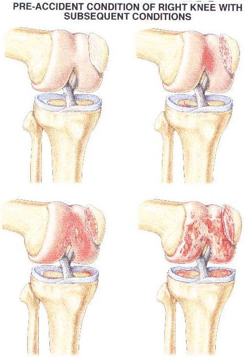 Pre-Accident Condition of Right Knee With Subsequent Conditions